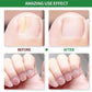 Nail Fungus Treatment
